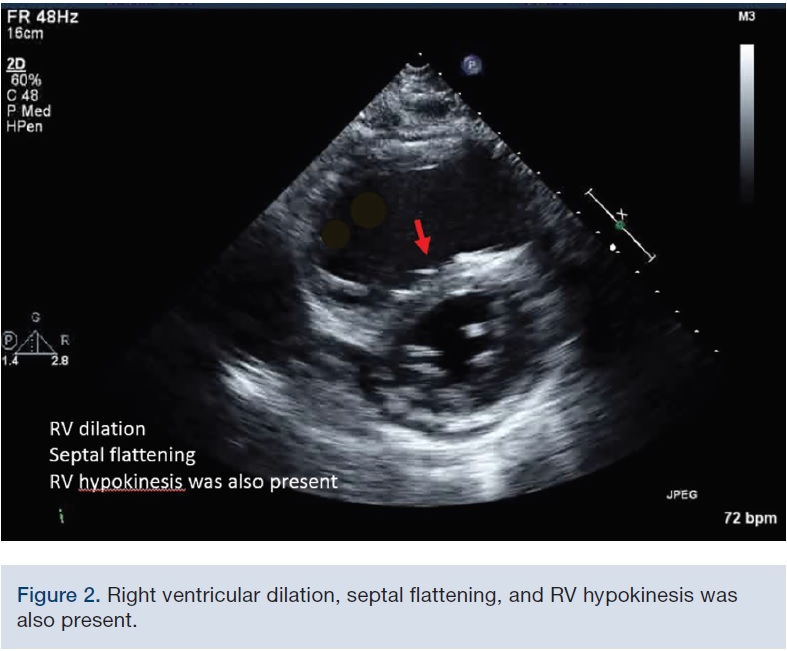 Very Low Dose and Shorter Duration CatheterDirected Thrombolytic Therapy Proves to be Safe and